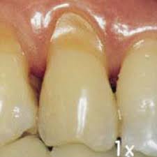 Abfraction lesions on teeth