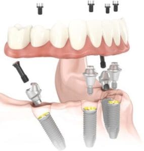 illustration of all-on -4 dental implants
