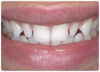 Smile Before Peg Lateral Correction