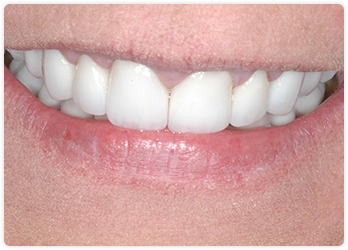Smile After Full Mouth Reconstruction