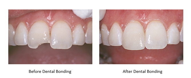 Chipped front tooth before and after dental bonding