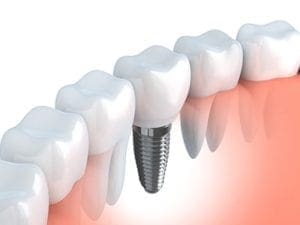 illustration of dental implant in a bite next to natural teeth