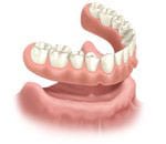Dentures about to rest on the bottom arch of teeth