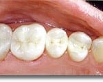 Photo showing white fillings