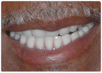 Smile After Dentures