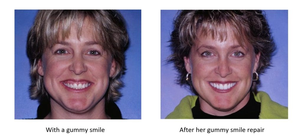 before and after a gummy smile