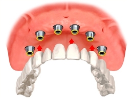 image of a dental implant overdenture