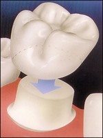metal free dental crown being placed
