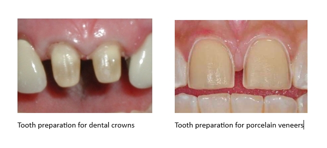 An image comparing the difference in tooth preparation between porcelain veneers and dental crowns.