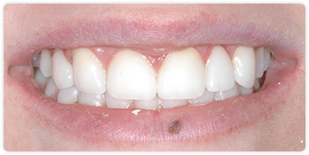 Smile After Maxillary Veneers