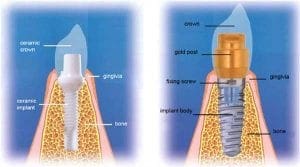 comparison of zirconia implant to titanium